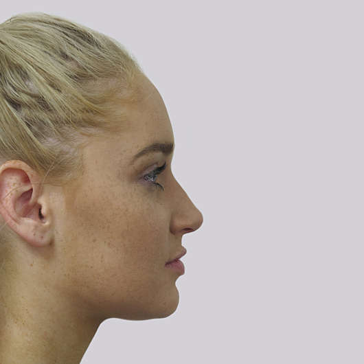 Dr Ha Rhinoplasty Before & After (Female) - Adelaide