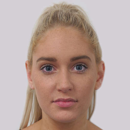Dr Ha Rhinoplasty Before & After (Female) - Adelaide