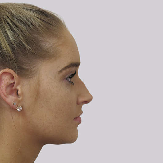 Dr Ha Rhinoplasty Before & After (Female) - Adelaide
