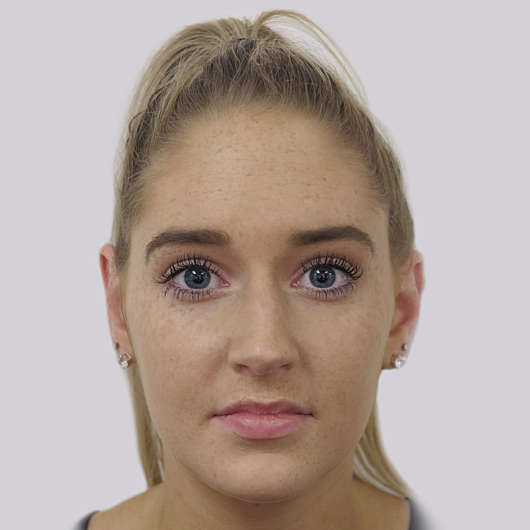 Dr Ha Rhinoplasty Before & After (Female) - Adelaide