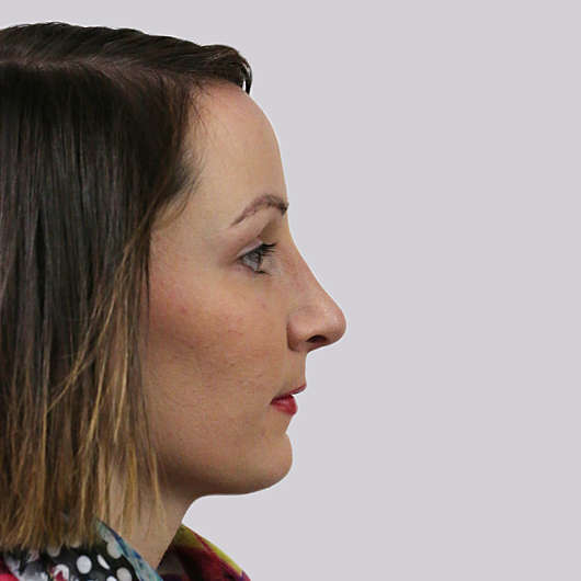 Dr Ha Rhinoplasty Before & After (Female) - Adelaide