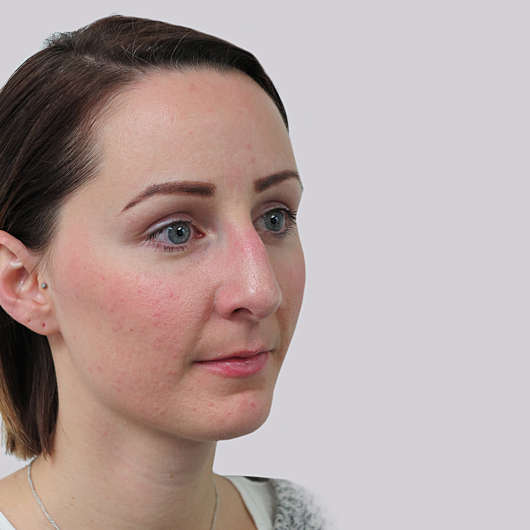 Dr Ha Rhinoplasty Before & After (Female) - Adelaide