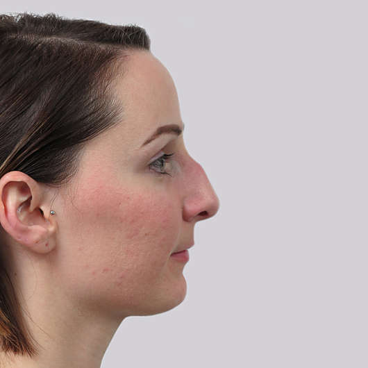 Dr Ha Rhinoplasty Before & After (Female) - Adelaide