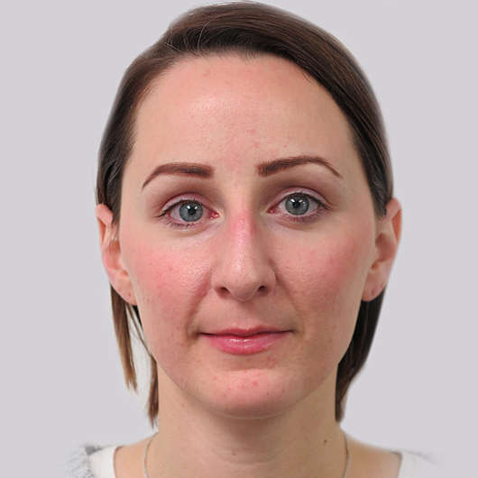 Dr Ha Rhinoplasty Before & After (Female) - Adelaide