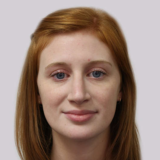 Dr Ha Rhinoplasty Before & After (Female) - Adelaide