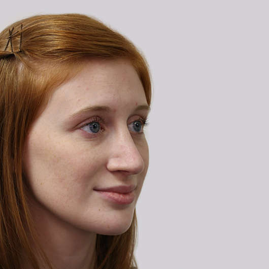 Dr Ha Rhinoplasty Before & After (Female) - Adelaide