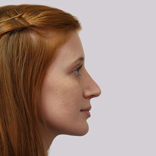 Dr Ha Rhinoplasty Before & After (Female) - Adelaide