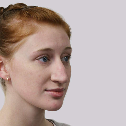 Dr Ha Rhinoplasty Before & After (Female) - Adelaide