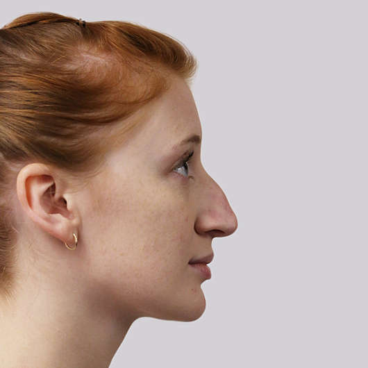 Dr Ha Rhinoplasty Before & After (Female) - Adelaide