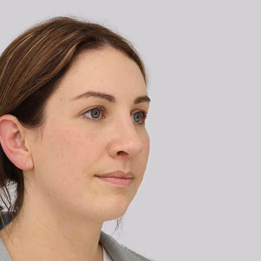 Dr Ha Rhinoplasty Before & After (Female) - Adelaide