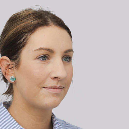 Dr Ha Rhinoplasty Before & After (Female) - Adelaide