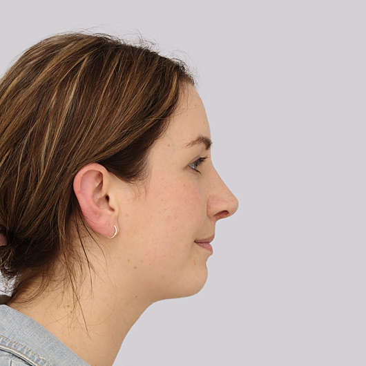 Dr Ha Rhinoplasty Before & After (Female) - Adelaide