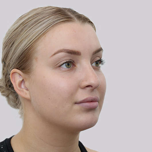 Dr Ha Rhinoplasty Before & After (Female) - Adelaide