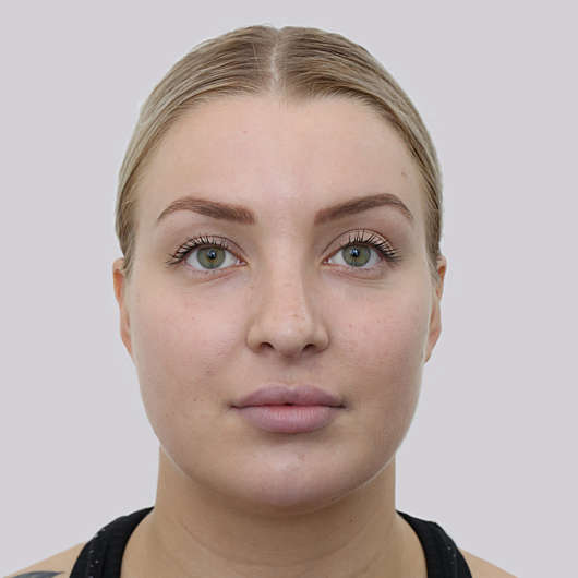 Dr Ha Rhinoplasty Before & After (Female) - Adelaide