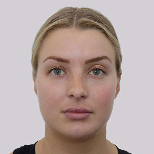 Dr Ha Rhinoplasty Before & After (Female) - Adelaide