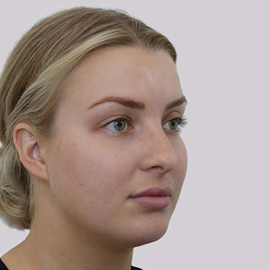 Dr Ha Rhinoplasty Before & After (Female) - Adelaide