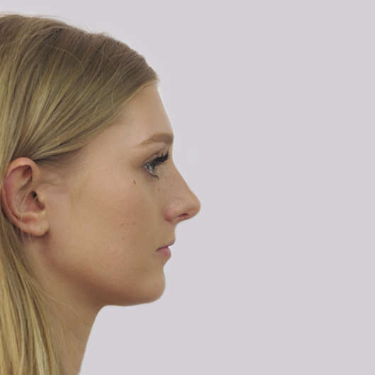 Dr Ha Rhinoplasty Before & After (Female) - Adelaide