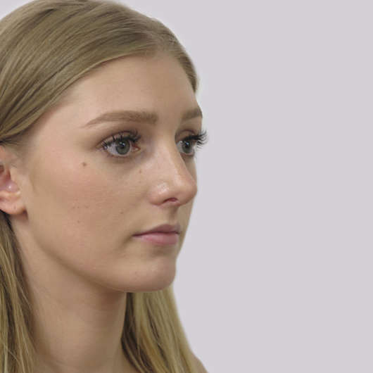 Dr Ha Rhinoplasty Before & After (Female) - Adelaide