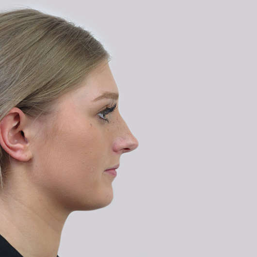 Dr Ha Rhinoplasty Before & After (Female) - Adelaide