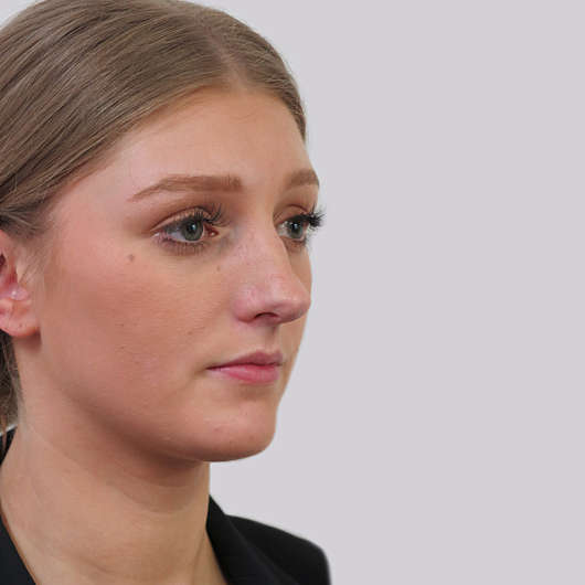 Dr Ha Rhinoplasty Before & After (Female) - Adelaide