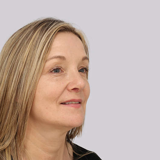 Dr Ha Rhinoplasty Before & After - Adelaide