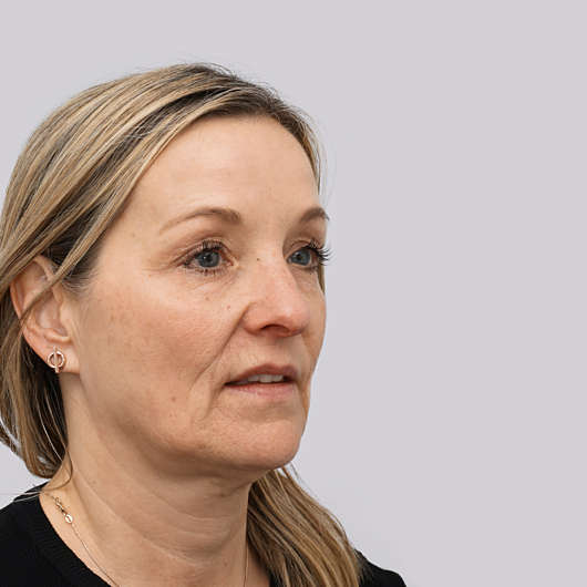 Dr Ha Rhinoplasty Before & After - Adelaide