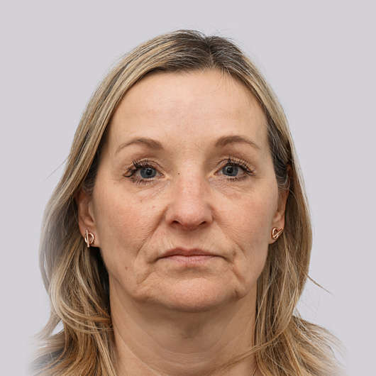 Dr Ha Rhinoplasty Before & After - Adelaide