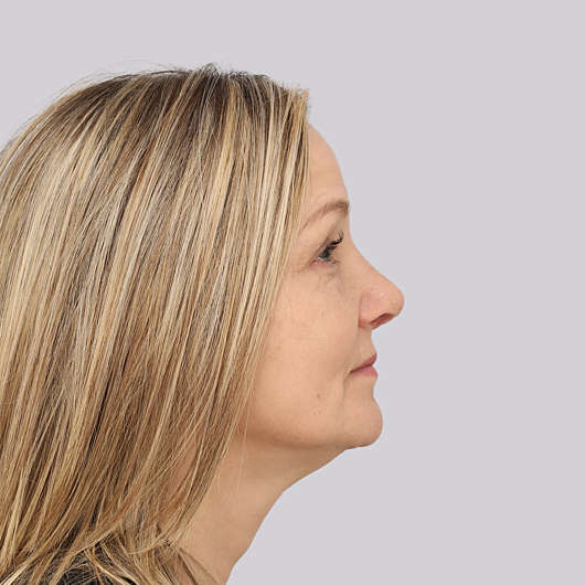 Dr Ha Rhinoplasty Before & After - Adelaide