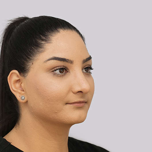 Dr Ha Rhinoplasty Before & After (Female) - Adelaide