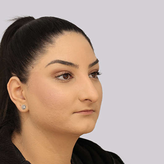 Dr Ha Rhinoplasty Before & After (Female) - Adelaide