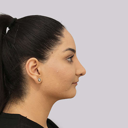 Dr Ha Rhinoplasty Before & After (Female) - Adelaide