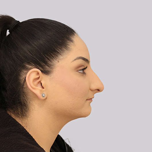 Dr Ha Rhinoplasty Before & After (Female) - Adelaide