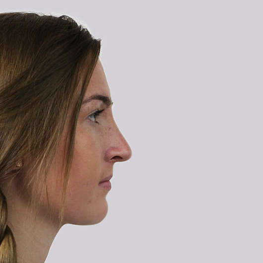 Dr Ha Rhinoplasty Before & After (Female) - Adelaide