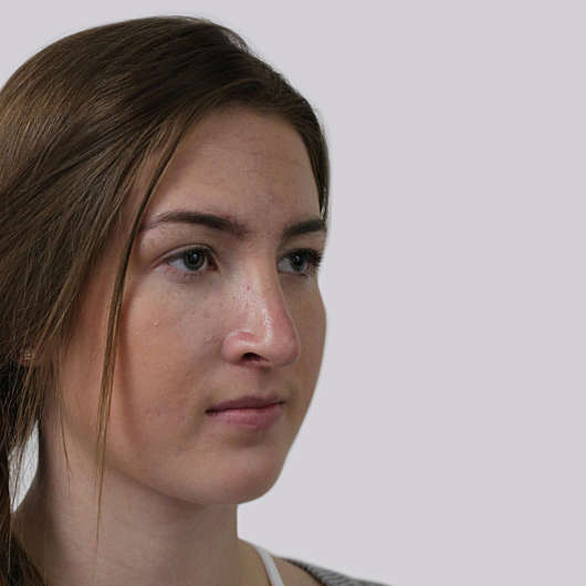 Dr Ha Rhinoplasty Before & After (Female) - Adelaide