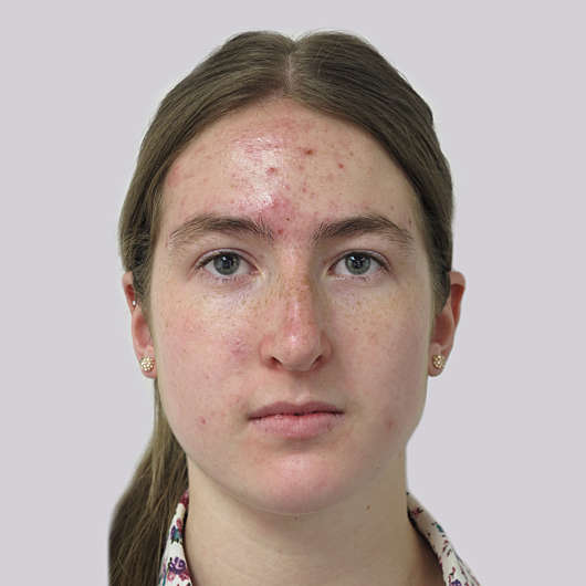 Dr Ha Rhinoplasty Before & After (Female) - Adelaide