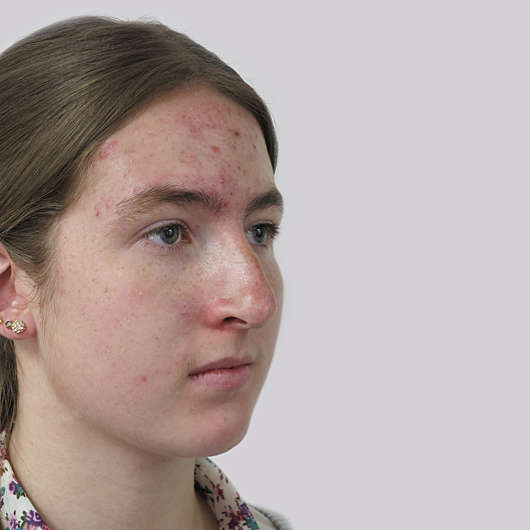 Dr Ha Rhinoplasty Before & After (Female) - Adelaide