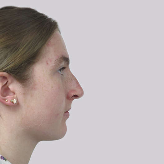 Dr Ha Rhinoplasty Before & After (Female) - Adelaide