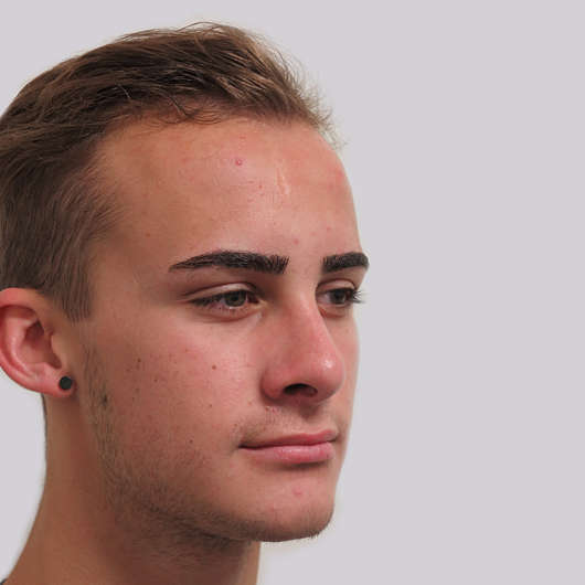 Dr Ha Rhinoplasty Before & After (Male) - Adelaide