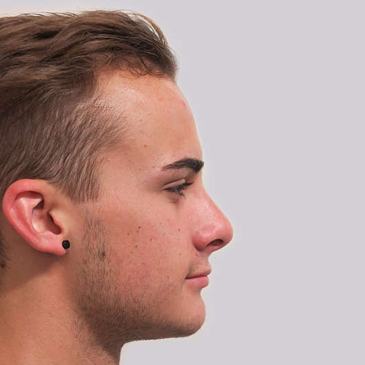 Dr Ha Rhinoplasty Before & After (Male) - Adelaide
