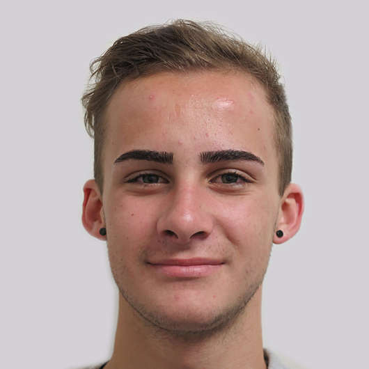 Dr Ha Rhinoplasty Before & After (Male) - Adelaide