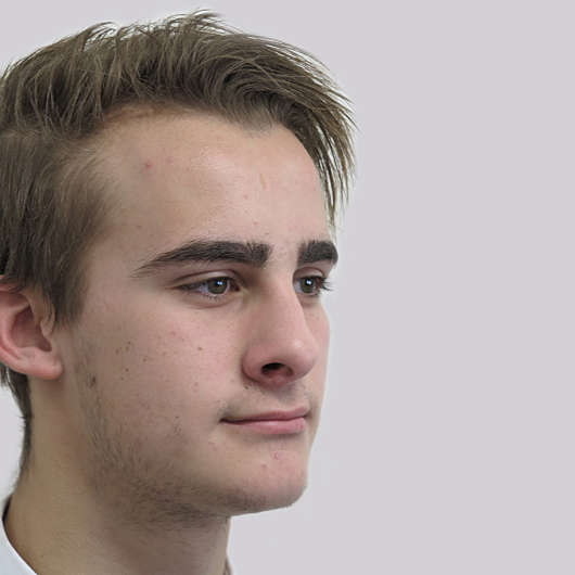 Dr Ha Rhinoplasty Before & After (Male) - Adelaide