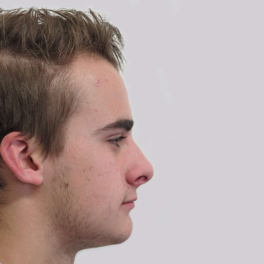 Dr Ha Rhinoplasty Before & After (Male) - Adelaide