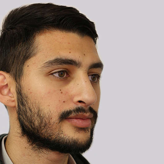 Dr Ha Rhinoplasty Before & After (Male) - Adelaide