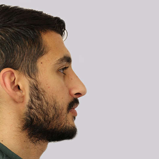 Dr Ha Rhinoplasty Before & After (Male) - Adelaide