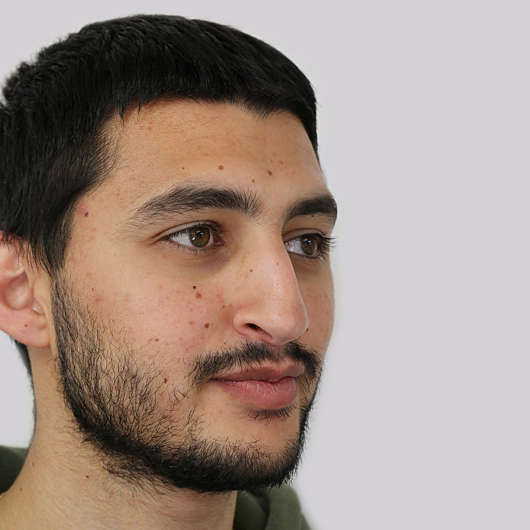 Dr Ha Rhinoplasty Before & After (Male) - Adelaide