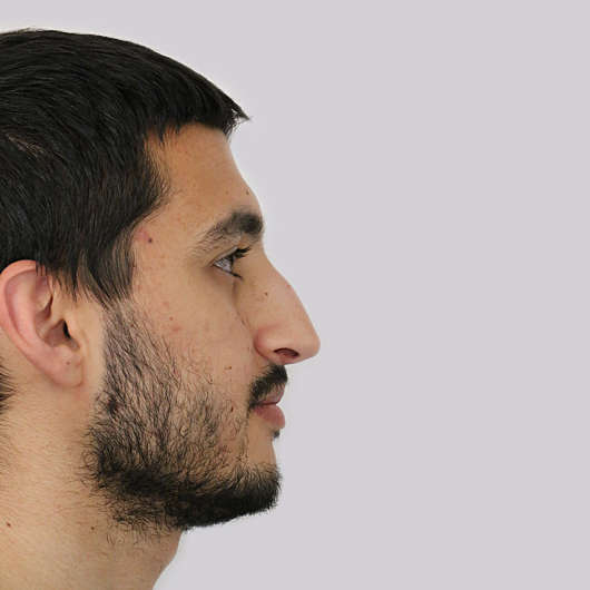 Dr Ha Rhinoplasty Before & After (Male) - Adelaide