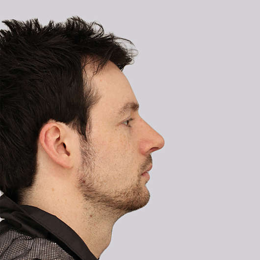 Dr Ha Rhinoplasty Before & After (Male) - Adelaide