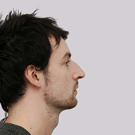 Dr Ha Rhinoplasty Before & After (Male) - Adelaide