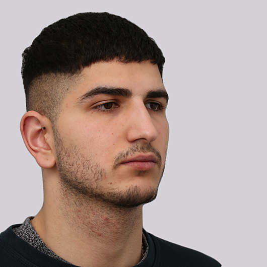 Dr Ha Rhinoplasty Before & After (Male) - Adelaide