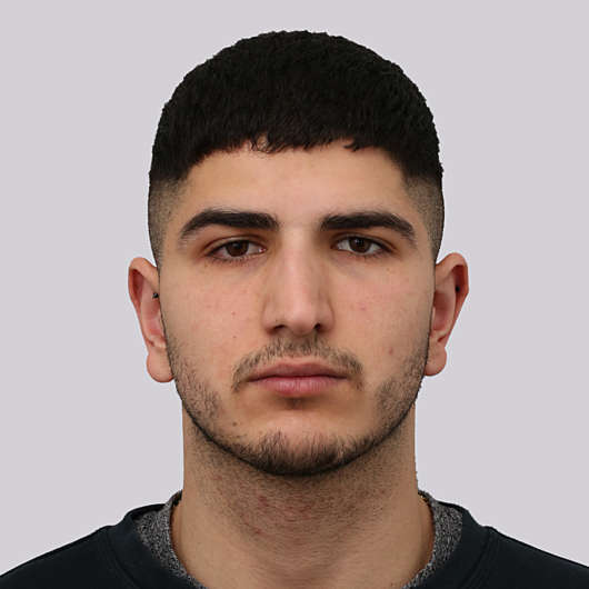 Dr Ha Rhinoplasty Before & After (Male) - Adelaide